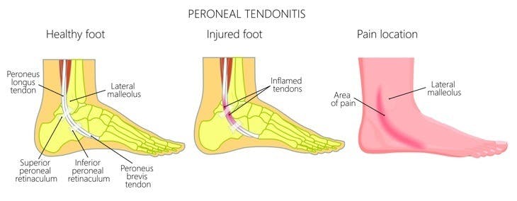 Peroneal Tendonitis: Area of pain