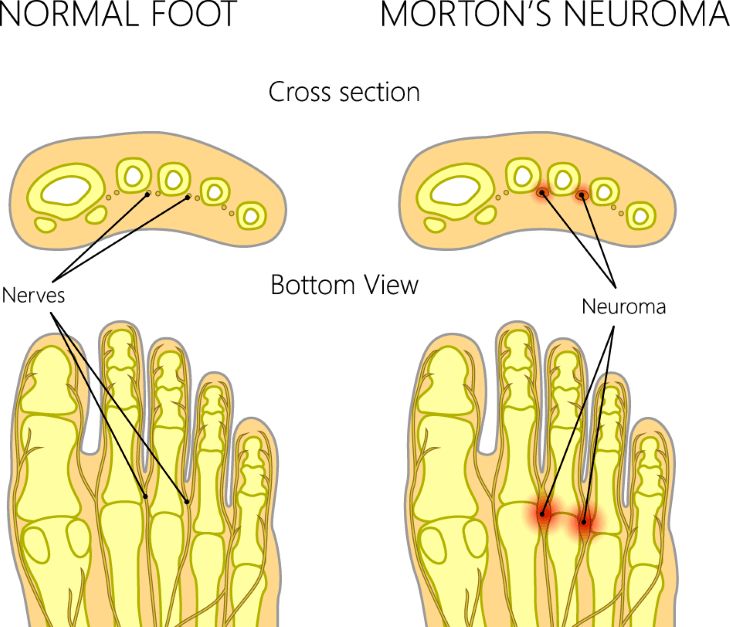 Normal foot vs. Mortons neuroma