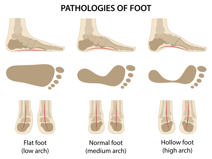 pathologies foot difference between normal arch, flat foot and high arch